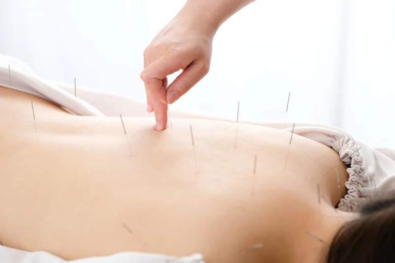 Does Acupuncture Actually Do Anything?
