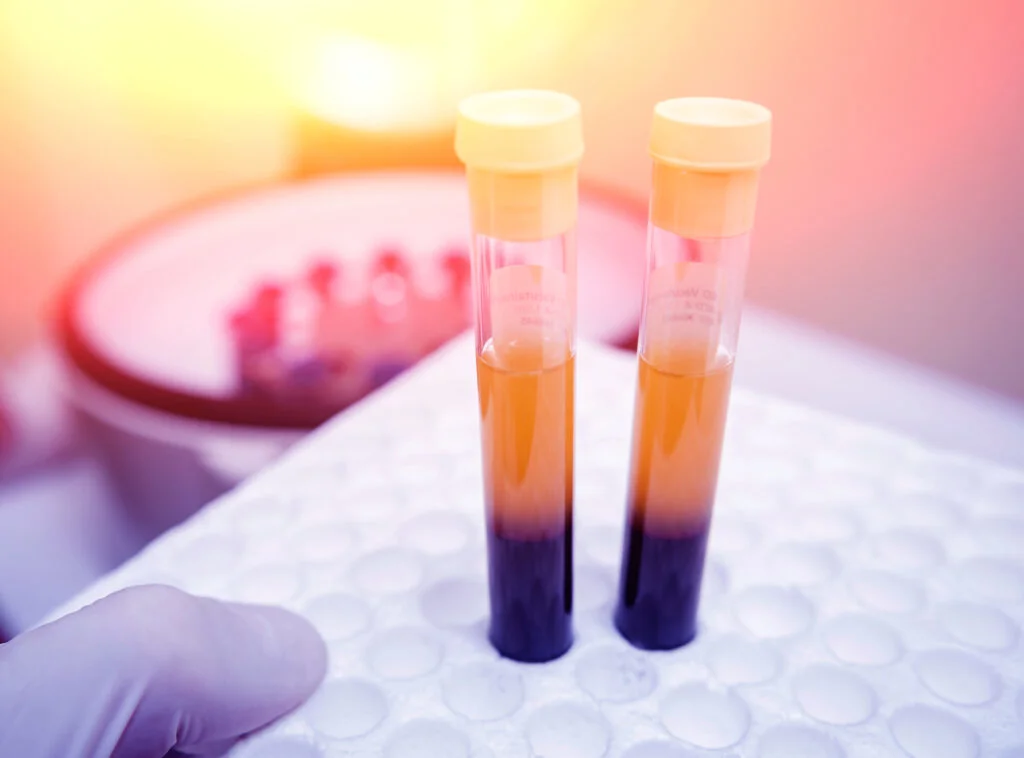 Platelet Rich Plasma vials