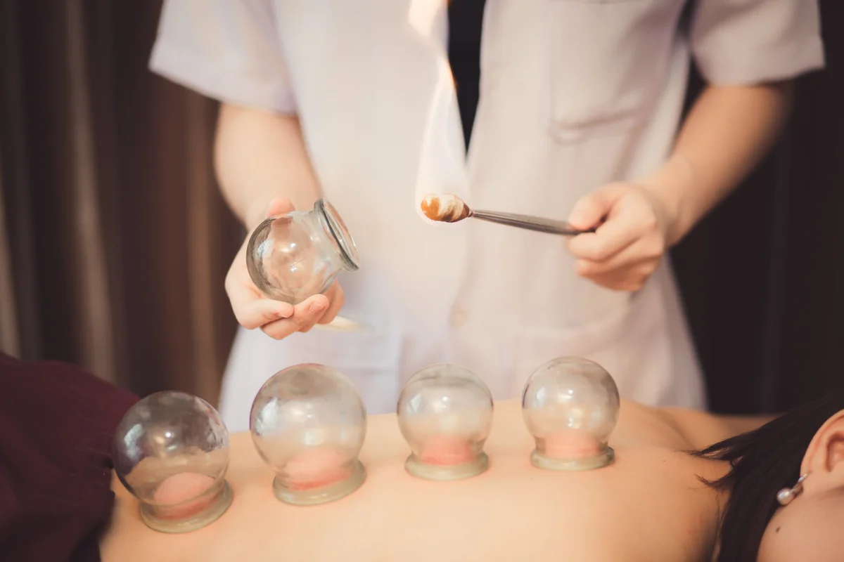 What are the Benefits of Using Cupping?