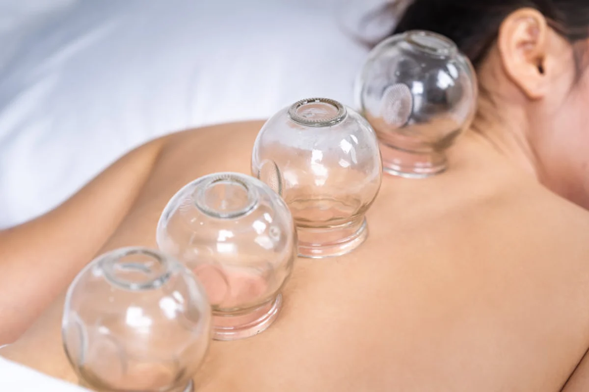 What Therapies Compliment Cupping?